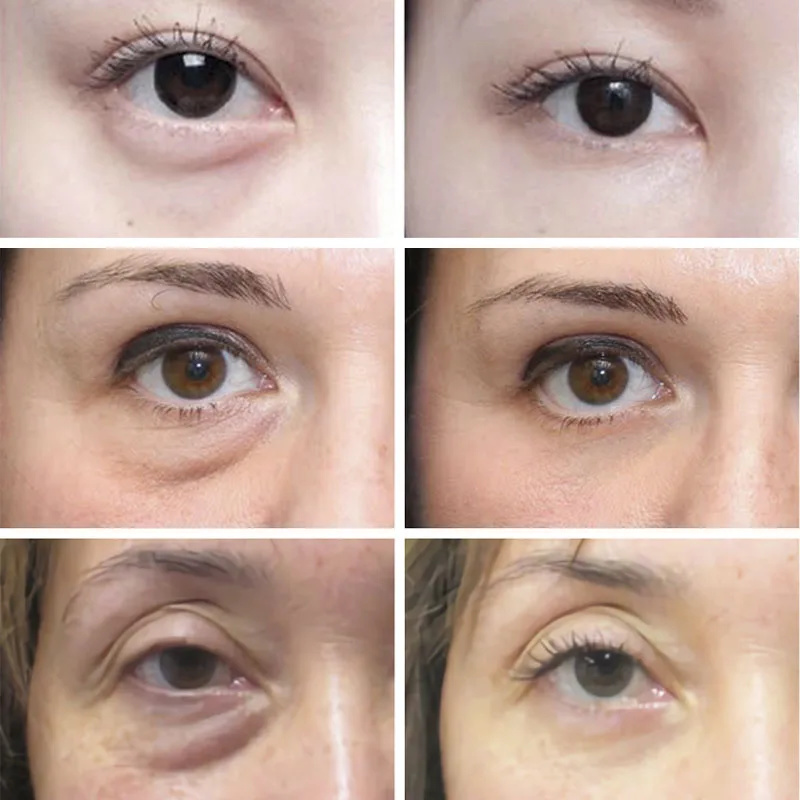 주름 방지 다크 서클 아이 크림 롤러 마사지기, 모이스 - Skincare D'Alba 리뷰 및 가격